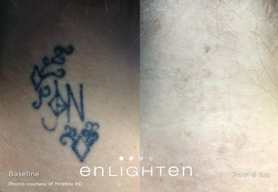 laser-tattoo-removal-before-and-after-sante_1 Laser Tattoo Removal Before and After Sante