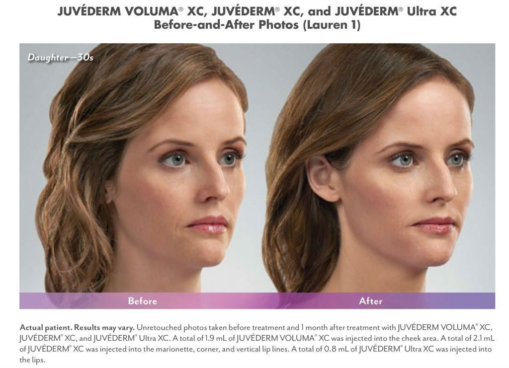 santesouthlake-botoxfillers2 botox