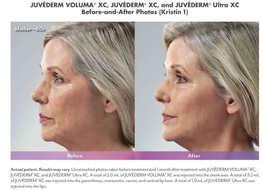 santesouthlake-botoxfillers3 botox