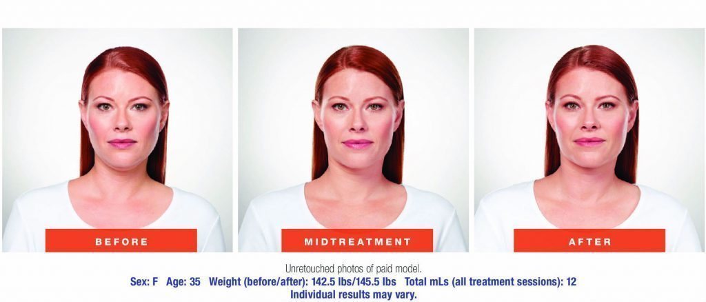 santesouthlake-kybella3 santesouthlake-kybella3