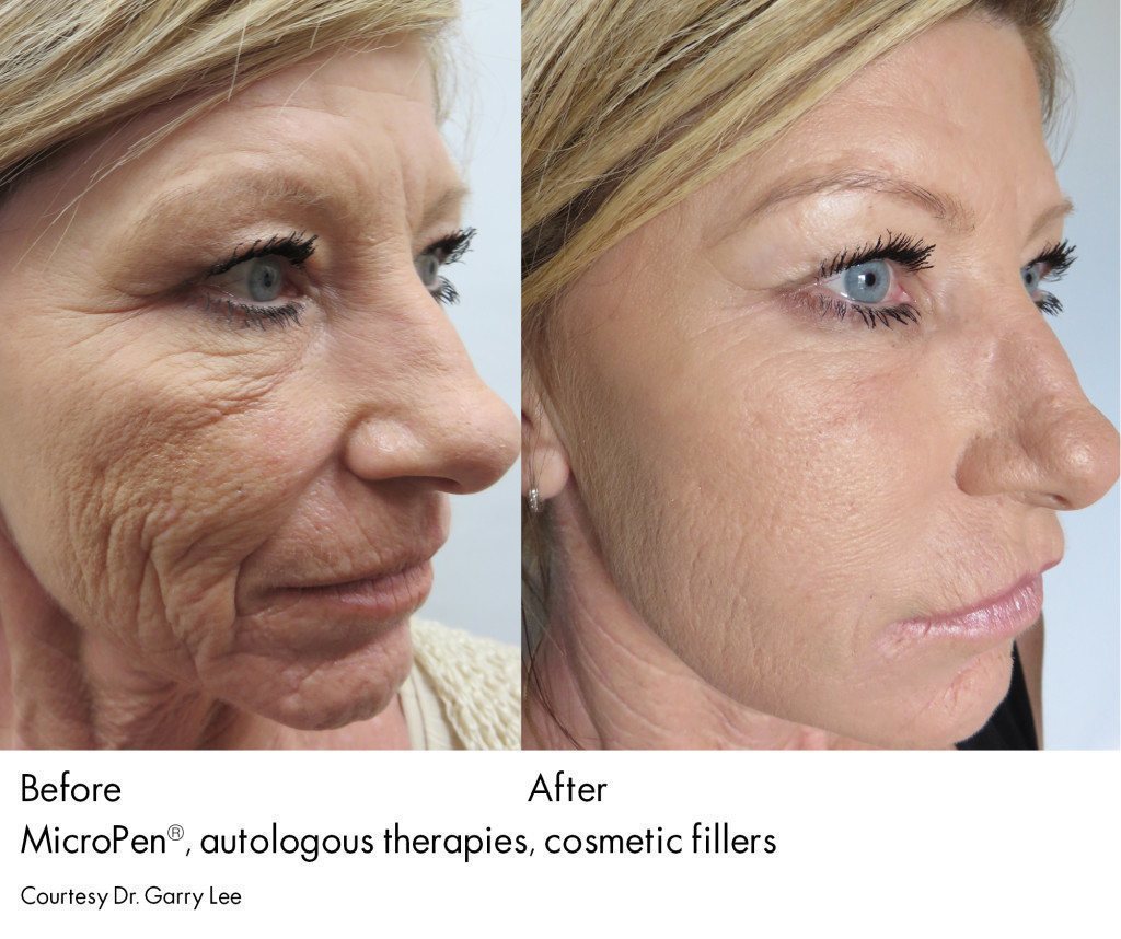 santesouthlake-microneedling3 santesouthlake-microneedling3