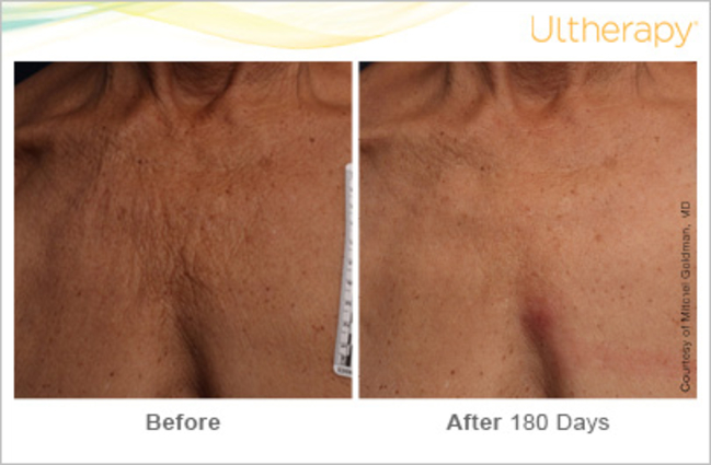 ultherapy-before-and-after-sante_5 Ultherapy Before and After Sante