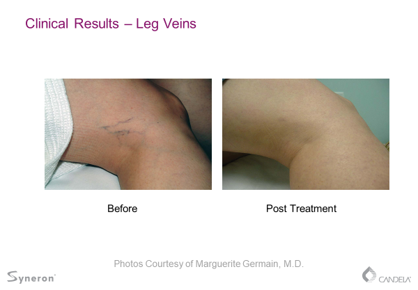 vein Laser Vein Treatment Before and After Sante