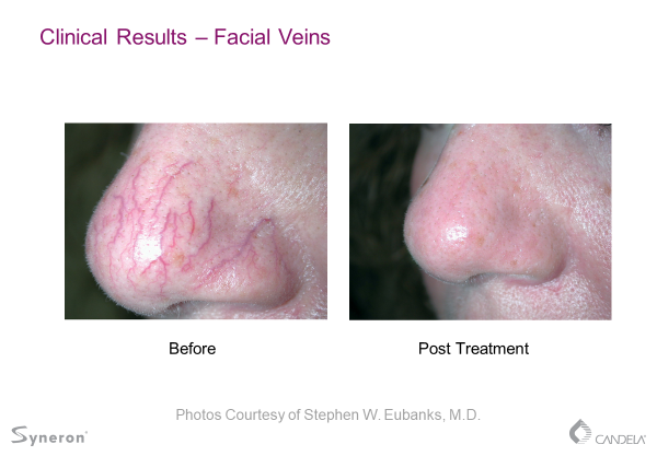 vein1 Laser Vein Treatment Before and After Sante