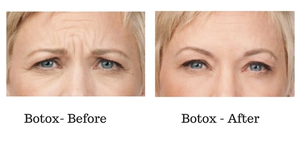 botox-before-and-after-sante_1 Botox Before and After Sante