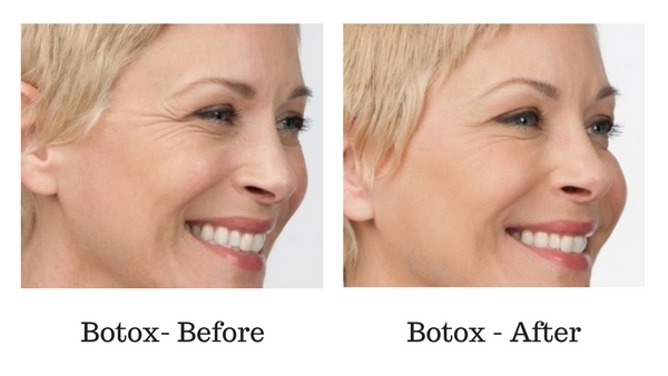 botox-before-and-after-sante_2 Botox Before and After Sante