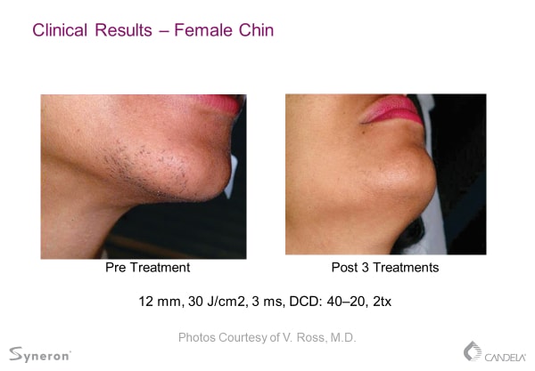 laser-hair-removal-before-and-after-sante-1 Laser Hair Removal Before and After Sante