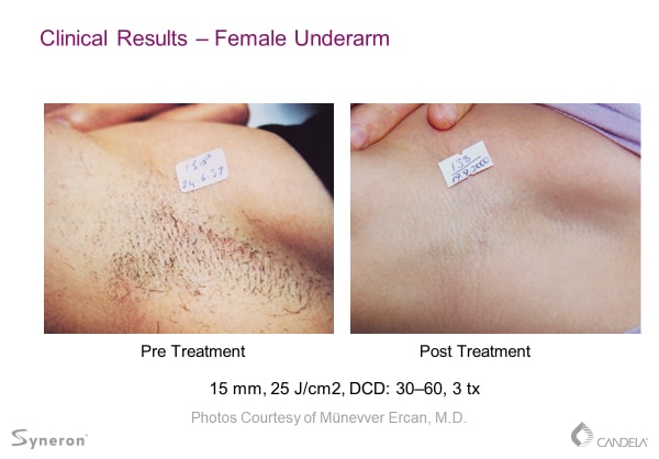 laser-hair-removal-before-and-after-sante-4 Laser Hair Removal Before and After Sante