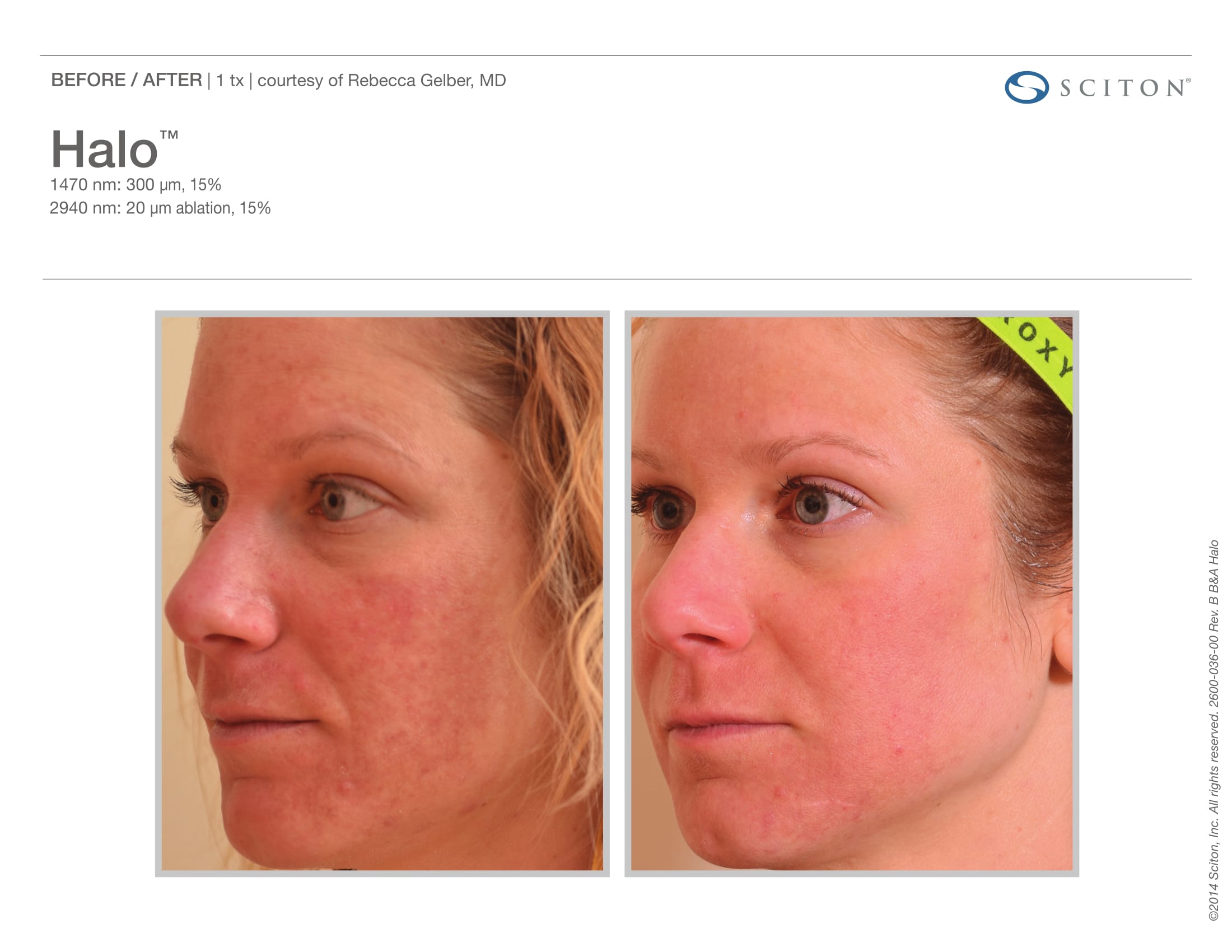 laser-skin-resurfacing-before-and-after-sante_1 Laser Skin Resurfacing Before and After Sante
