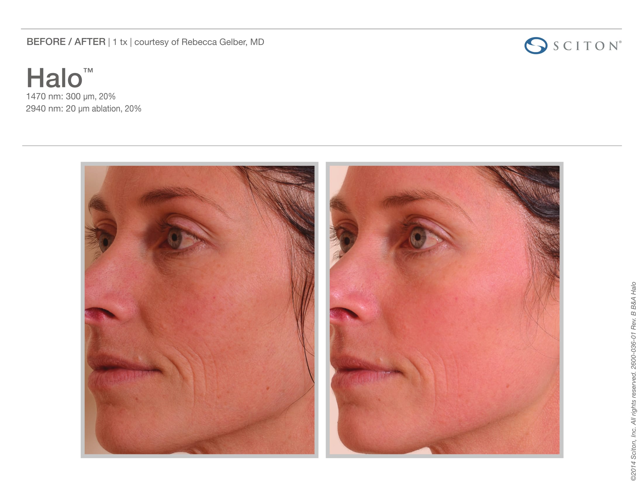 laser-skin-resurfacing-before-and-after-sante_2 Laser Skin Resurfacing Before and After Sante