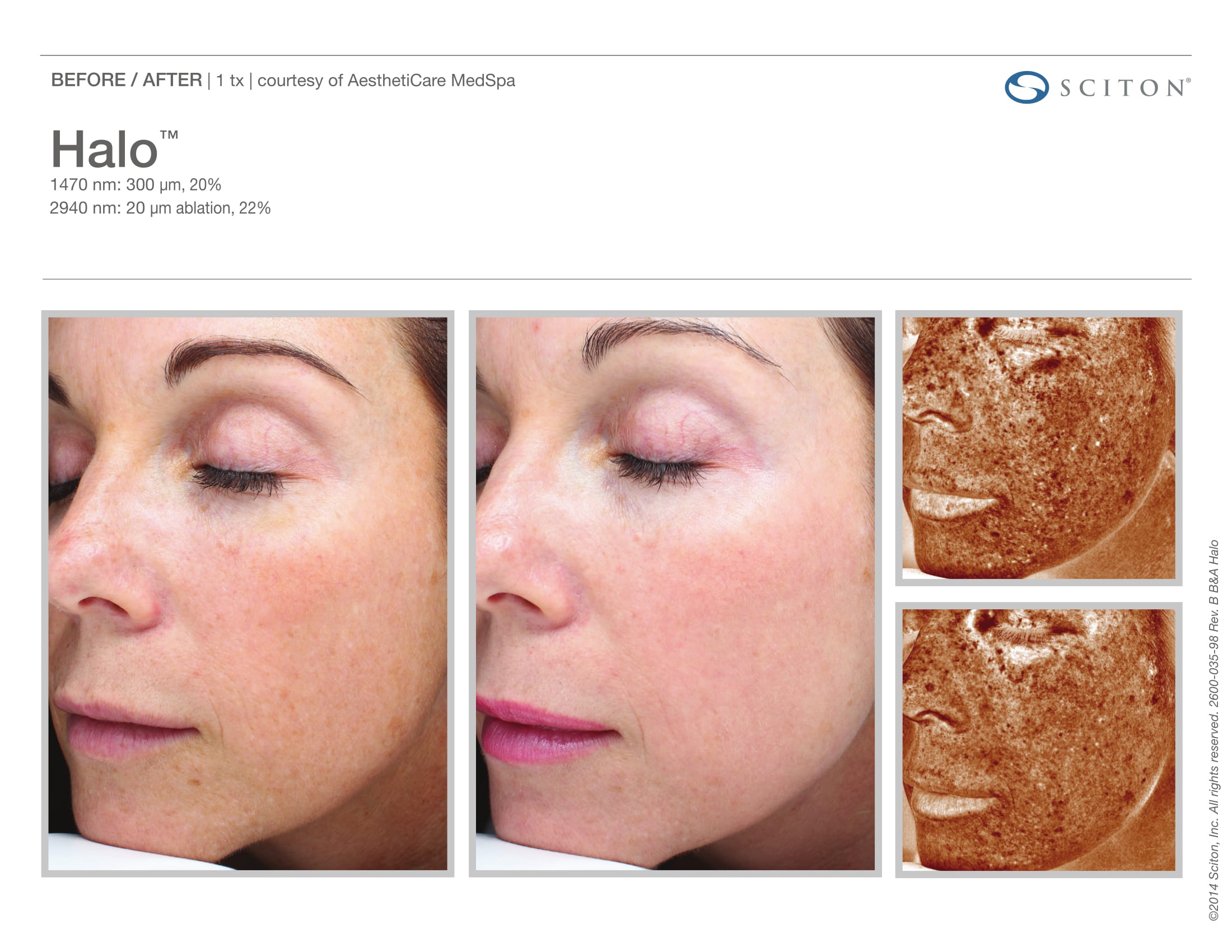 laser-skin-resurfacing-before-and-after-sante_3 Laser Skin Resurfacing Before and After Sante