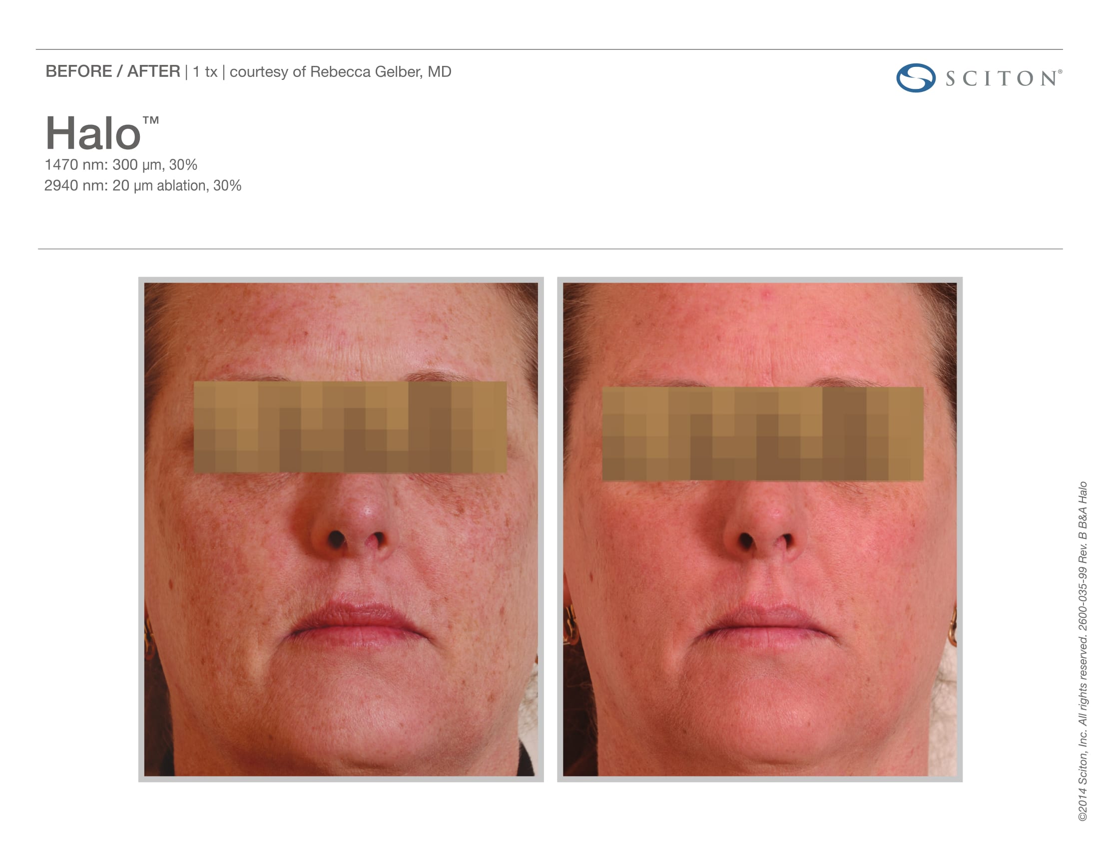 laser-skin-resurfacing-before-and-after-sante_4 Laser Skin Resurfacing Before and After Sante