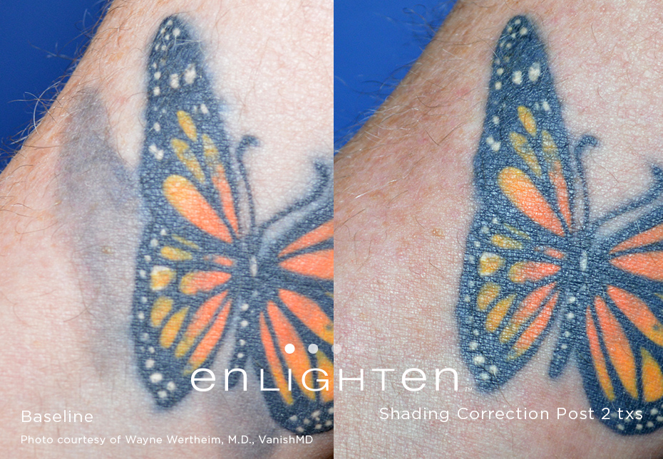 laser-tattoo-removal-before-and-after-sante_2 Laser Tattoo Removal Before and After Sante