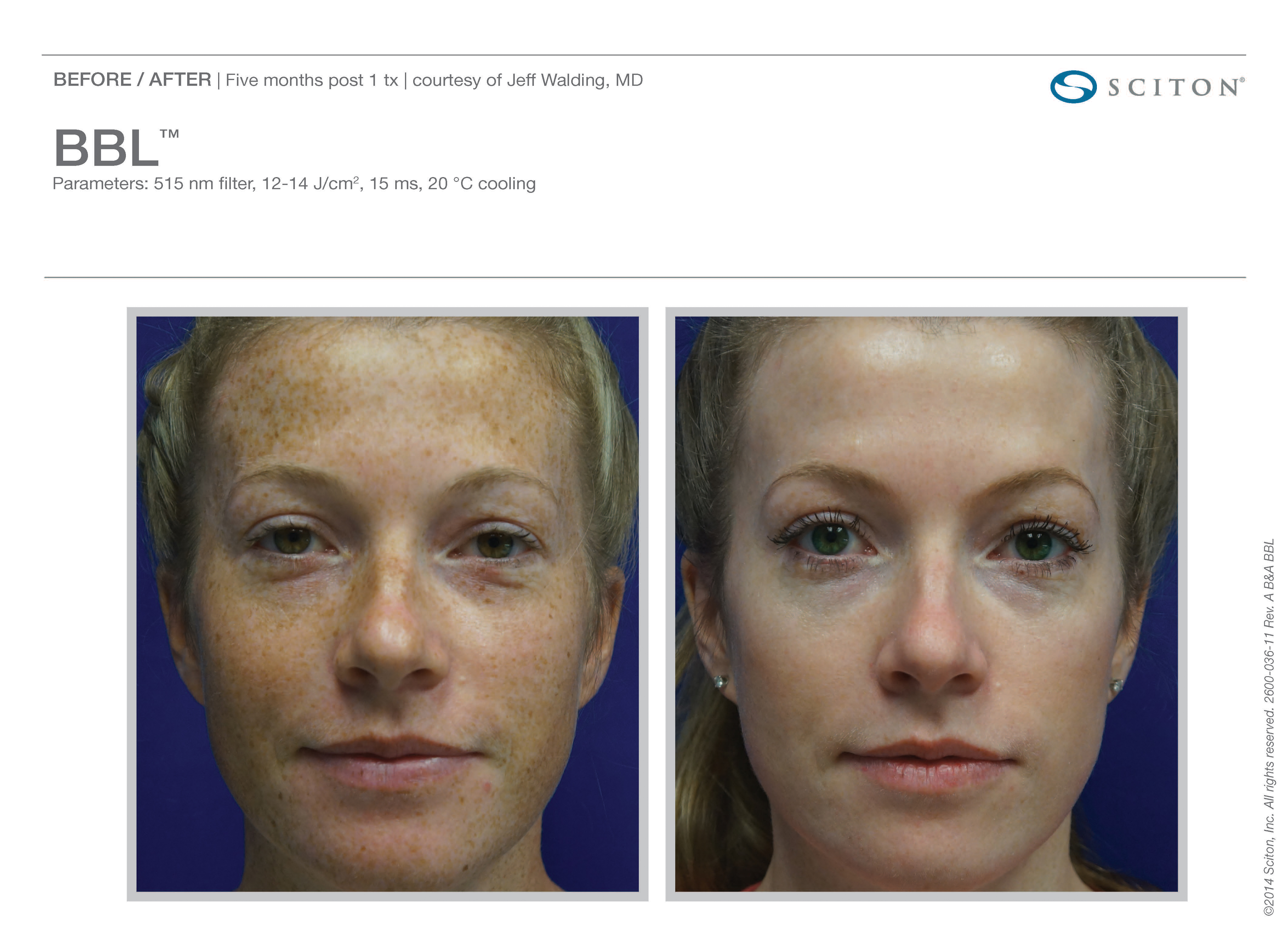 photofacial-before-and-after-sante_1 Photofacial Before and After Sante