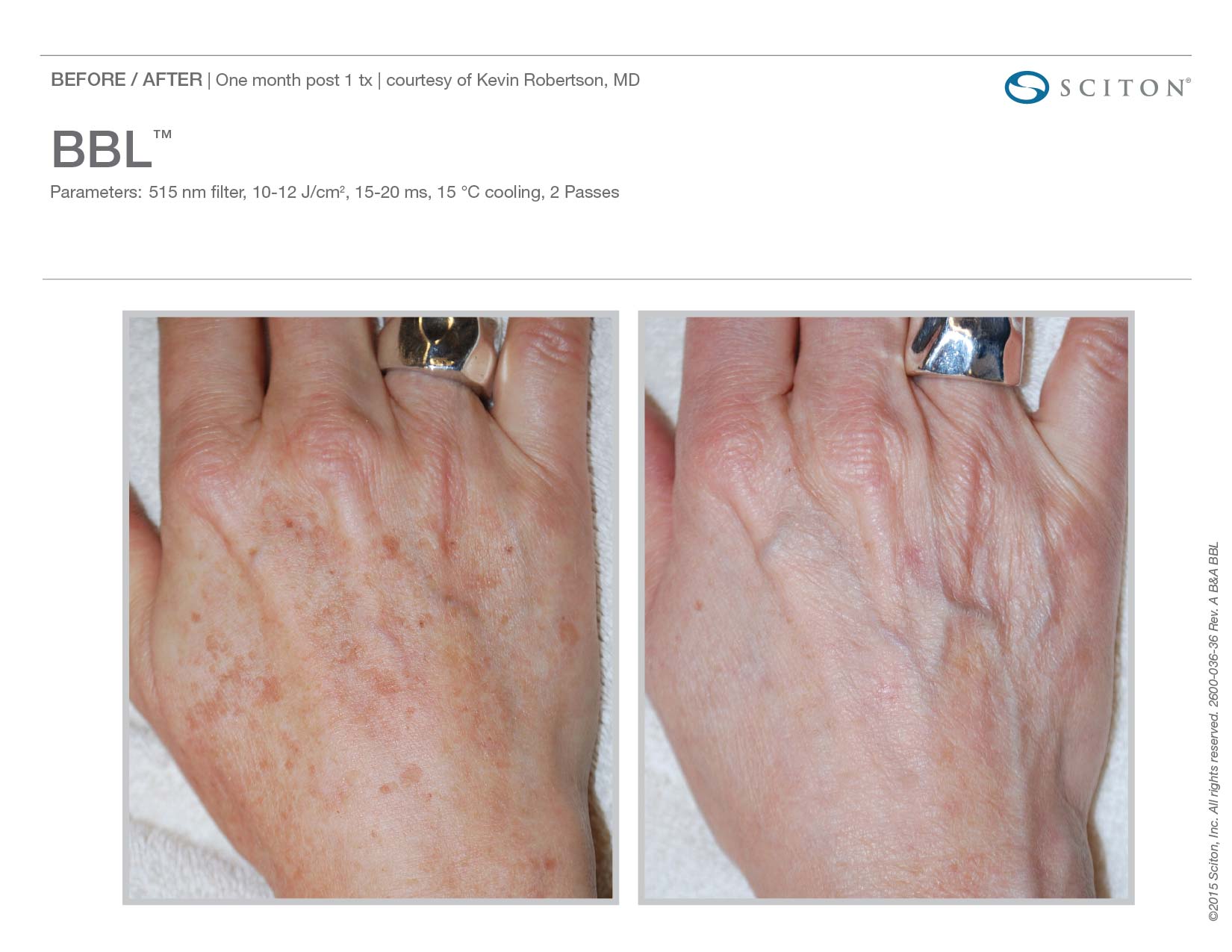 photofacial-before-and-after-sante_3 Photofacial Before and After Sante