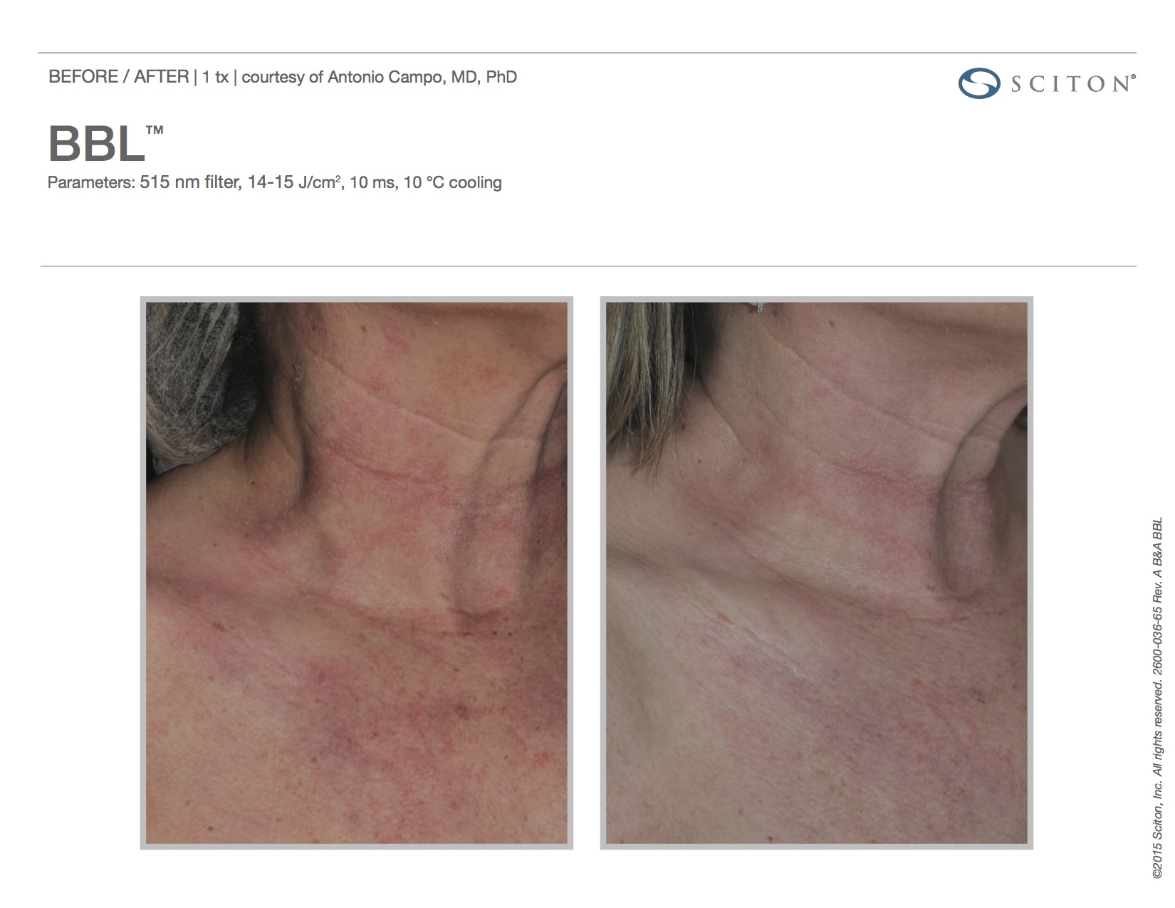 photofacial-before-and-after-sante_4 Photofacial Before and After Sante