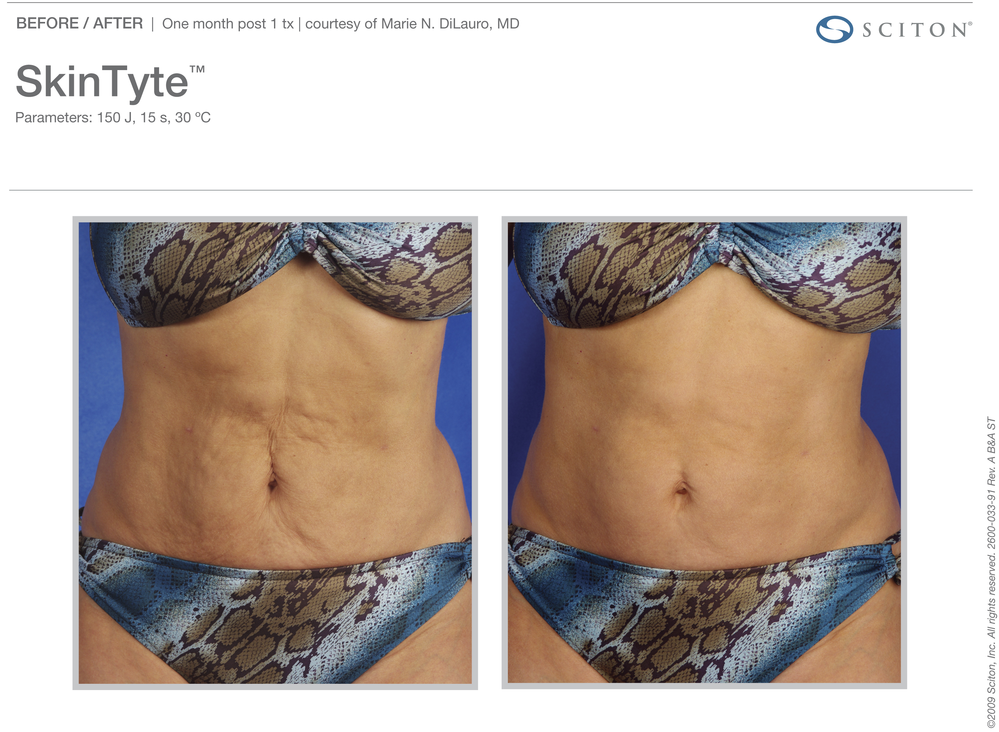 Skin Tyte Laser Before and After Sante Skin Tyte Laser Before and After Sante