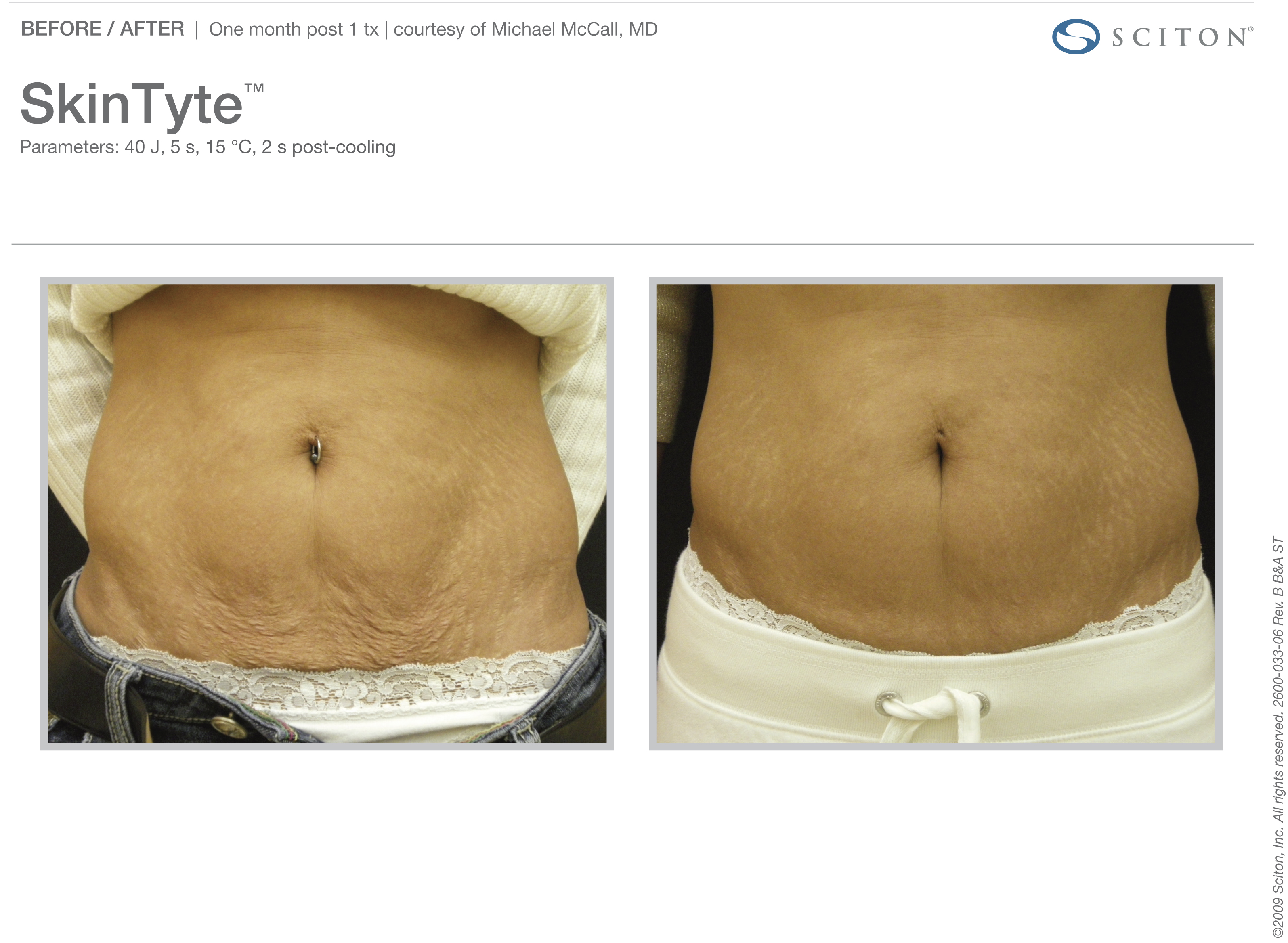 Skin Tyte Laser Before and After Sante Skin Tyte Laser Before and After Sante