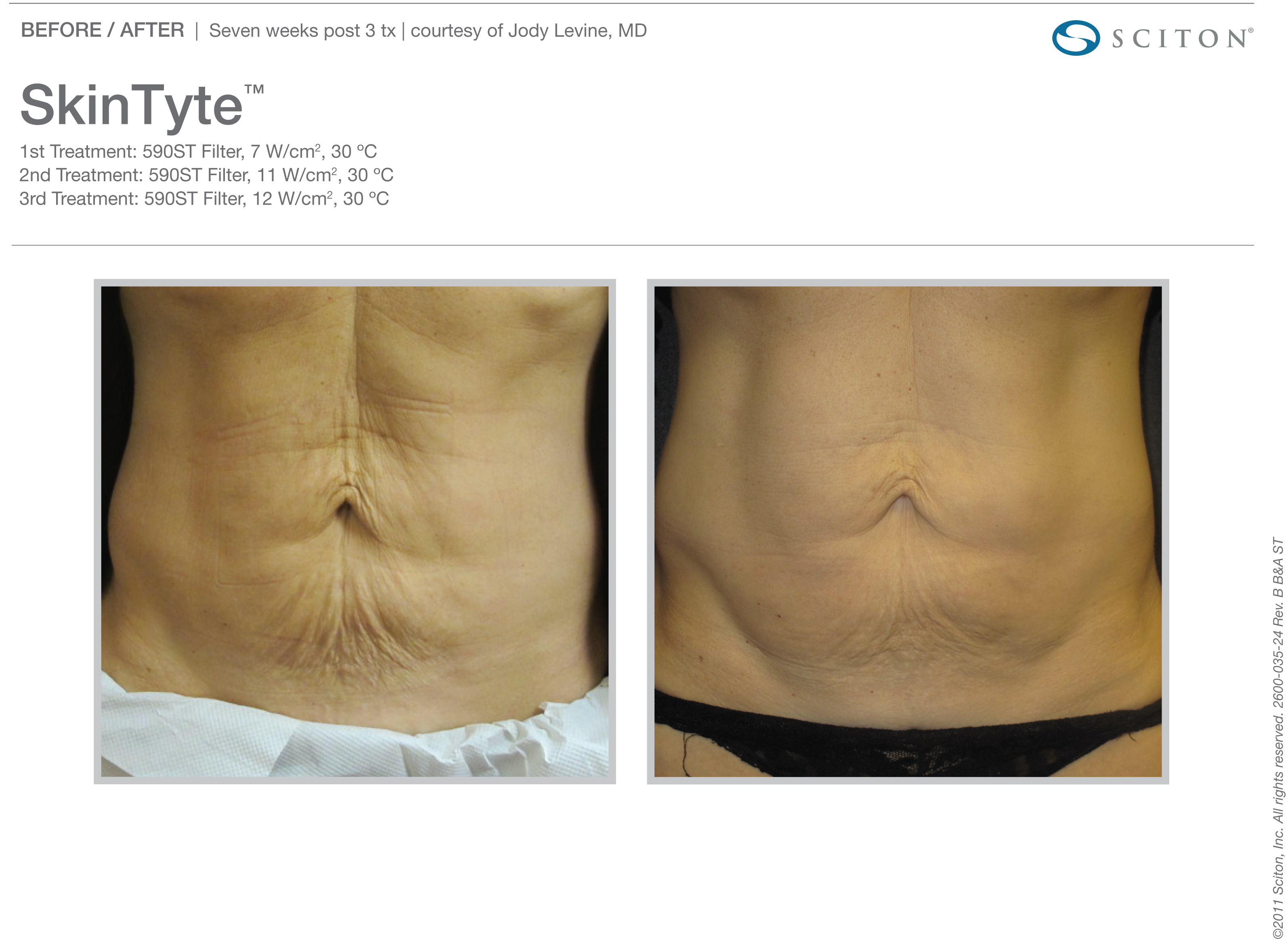 Skin Tyte Laser Before and After Sante Skin Tyte Laser Before and After Sante