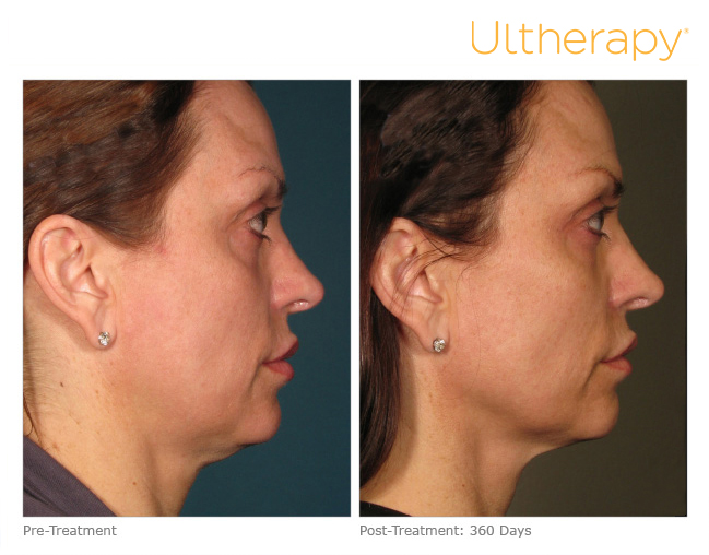 Ultherapy Before and After Sante Ultherapy Before and After Sante
