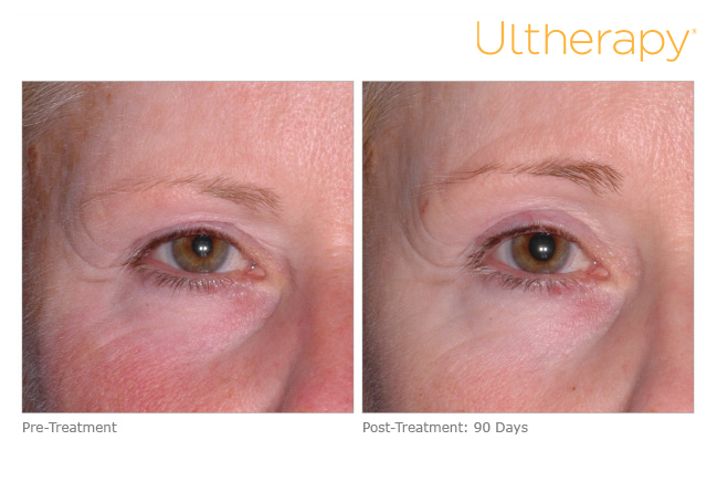 ultherapy-before-and-after-sante_4 Ultherapy Before and After Sante